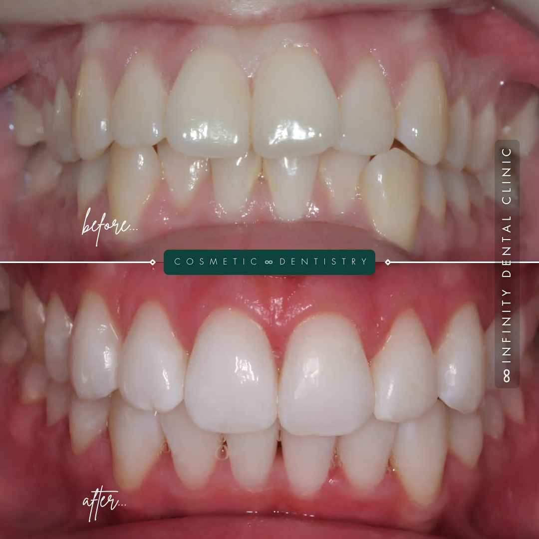 Full Arch Before and After (7)