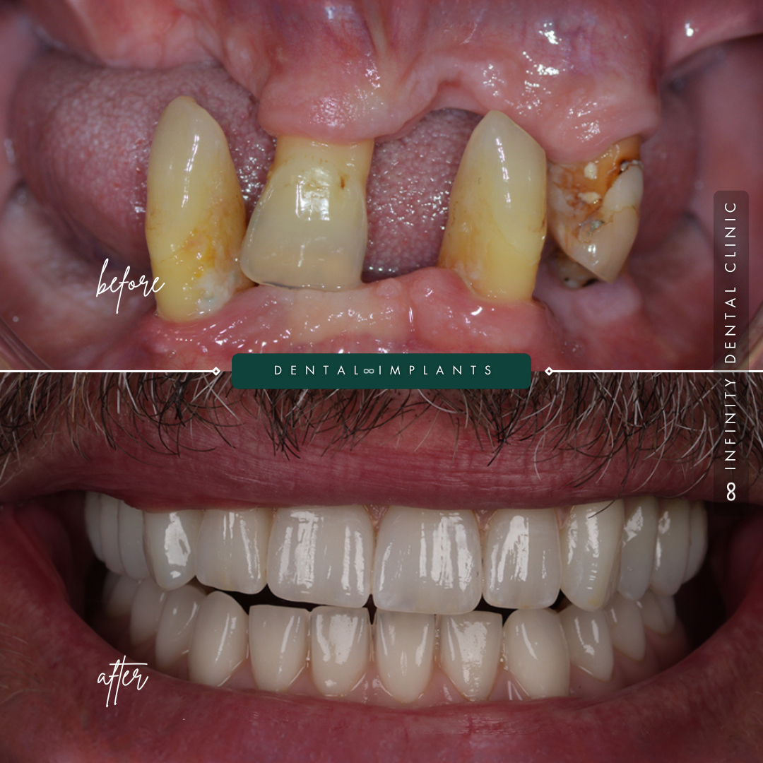 TEETH TRANSFORMATIONS - 2025-03-28T102931.350 TEETH TRANSFORMATIONS - 2025-03-28T102931.350